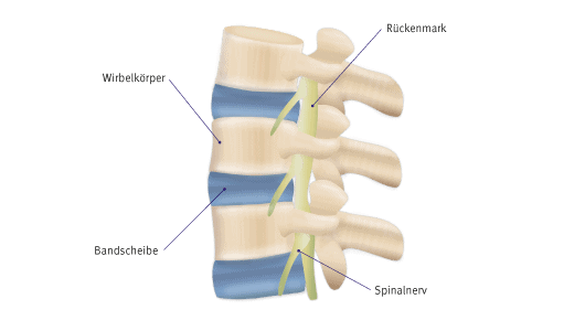 Seitenansicht einer Wirbelsäule. Drei Wirbel, die von einer Bandscheibe getrennt werden. Rechts befinden sich das Rückenmark und der Spinalnerv.