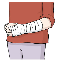 Verbundener Arm